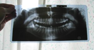 Viisaudenhammas särky 2008